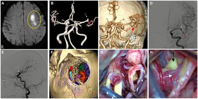 False positive angiographic aneurysm of the anterior segment of the M1 bifurcation of the middle cerebral artery: a case report